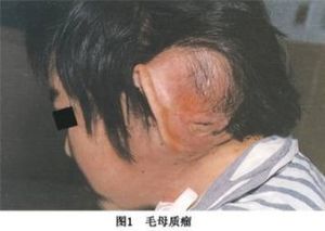毛母質瘤 毛母質瘤