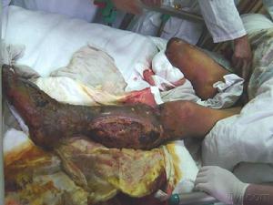 骨折晚期合併症 骨折晚期合併症