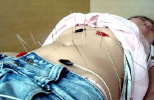 針炙減肥 針炙減肥