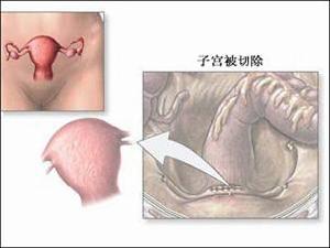 《筋膜內子宮切除術》