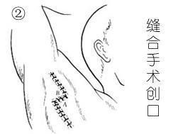 腋臭手術 腋臭手術