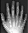 （圖）中央多指畸形的右手