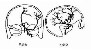 （圖）腦膜瘤細胞