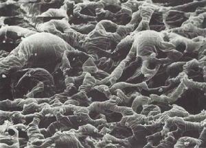 匐行性脈絡膜炎