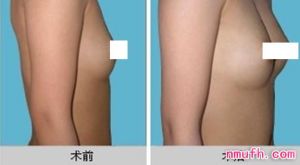 韓式仿生隆胸 韓式仿生隆胸