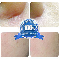 妙芙樂痘印無痕修護乳使用圖片