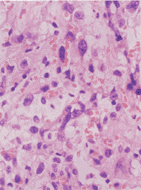 （圖）惡性血管內皮細胞瘤