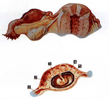 （圖）妊娠合併白血病