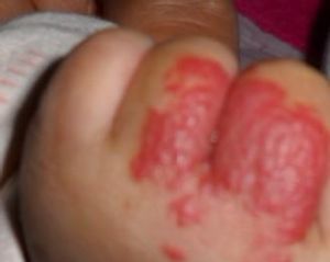 靜脈畸形 靜脈畸形