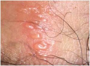 復發性皰疹 復發性皰疹