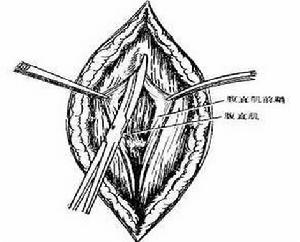 腹直肌鞘內血腫 腹直肌鞘內血腫