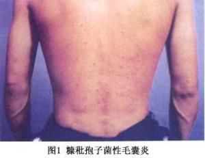 糠秕孢子菌毛囊炎 糠秕孢子菌毛囊炎