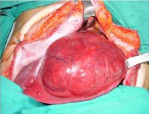 肝細胞腺瘤 肝細胞腺瘤