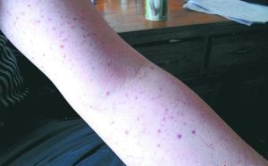 藥物性紫癜 藥物性紫癜