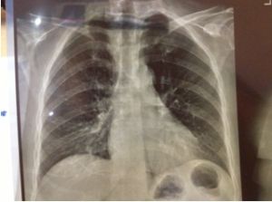 肺部纖維化 肺部纖維化