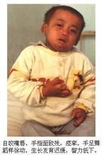 小兒糖原貯積病Ⅲ型 小兒糖原貯積病Ⅲ型