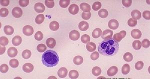 左側可見一正常的、成熟的淋巴細胞，右側是與其比較的分葉核嗜中性粒細胞。RBC是正常的淋巴細胞的23大小。