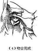 （圖）冠狀動脈異位起源