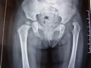 先天性髖脫位 先天性髖脫位