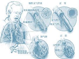 季節易發哮喘 季節易發哮喘