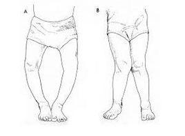 腿前內側出現感覺異常 腿前內側出現感覺異常