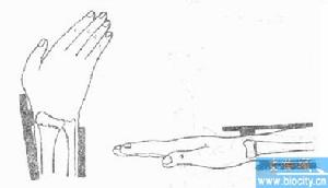 尺橈骨幹雙骨折