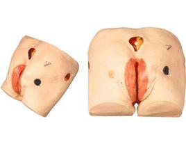 壓瘡護理模型 壓瘡護理模型