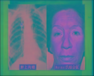 霍納氏綜合症 霍納氏綜合症