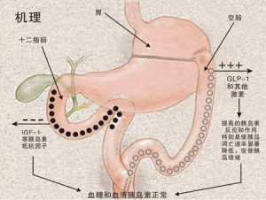 中國式胃轉流手術
