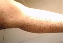 老年人免疫性血小板減少性紫癜 老年人免疫性血小板減少性紫癜