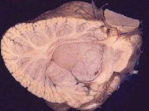 室管膜瘤 室管膜瘤