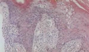 人乳頭瘤病毒感染