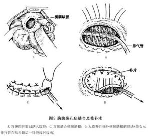 先天性胸骨旁疝