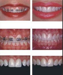 成人矯正 成人矯正