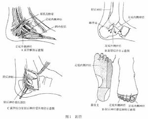 （圖）跖管綜合徵