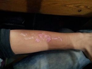 局限性神經性皮炎