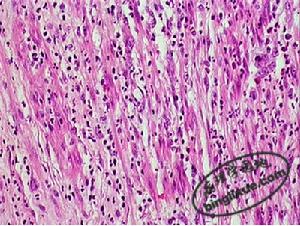 圖11蜂窩織炎(闌尾) 肌層瀰漫性中性粒細胞浸潤伴壞死