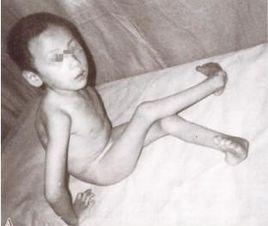 痙攣性腦性癱瘓 痙攣性腦性癱瘓