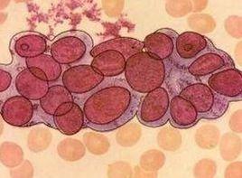 血清甲胎蛋白升高 血清甲胎蛋白升高