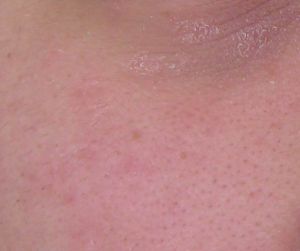 脂溢性濕疹 脂溢性濕疹