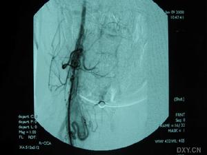 顱內肉芽腫性動脈炎