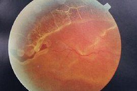 孔源性視網膜脫離 孔源性視網膜脫離