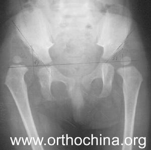 先天性髖關節脫位