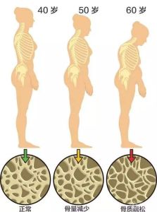 絕經後骨質疏鬆