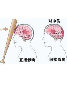 腦損傷 腦損傷