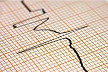 24小時動態心電圖