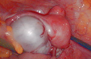 （圖）卵巢未成熟畸胎瘤