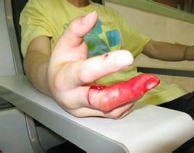 被西藏竹葉青蛇咬後