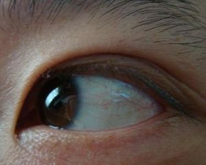 後鞏膜炎 後鞏膜炎