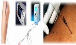 德國EVLT鐳射雷射微創術 德國EVLT鐳射雷射微創術